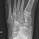 Radiographie osseuse