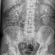 Urographie intraveineuse