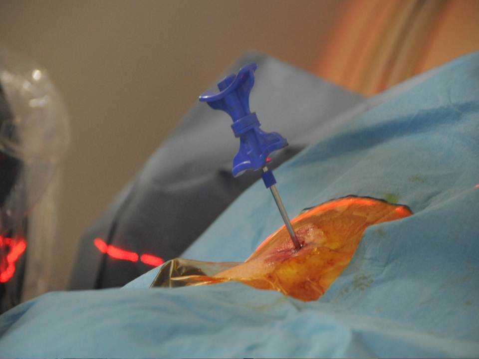 figure-3-perforated-trocar-is-inserted